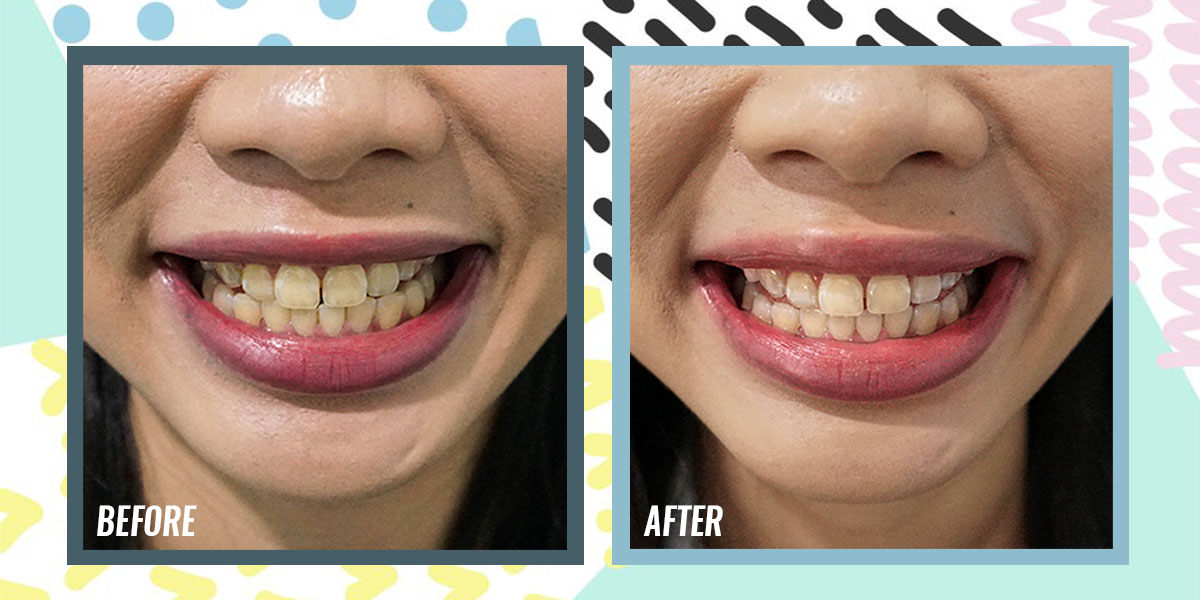 This S$168 Teeth Whitening Promo At La Vie Aesthetics Lightens Up To 8 Shades In 1 Session
