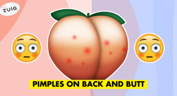 5-Step Guide To Get Rid Of Back And Butt Acne