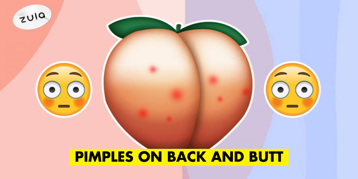 5-Step Guide To Get Rid Of Back And Butt Acne