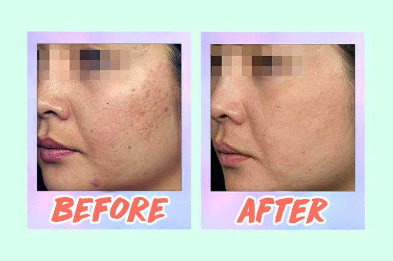 5 Acne Scar Laser Treatments In Singapore From S88 That Work—Including