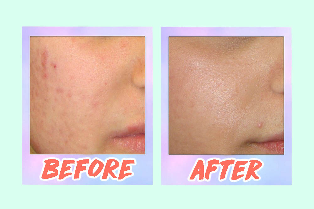 Laser Treatment On Acne Scars Before And Afters