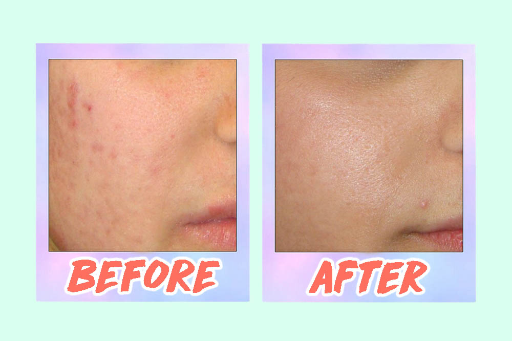 5 Acne Scar Laser Treatments In Singapore From S 88 That Work