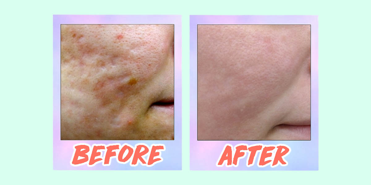 5 Acne Scar Laser Treatments In Singapore From S88 That Work—including 9777