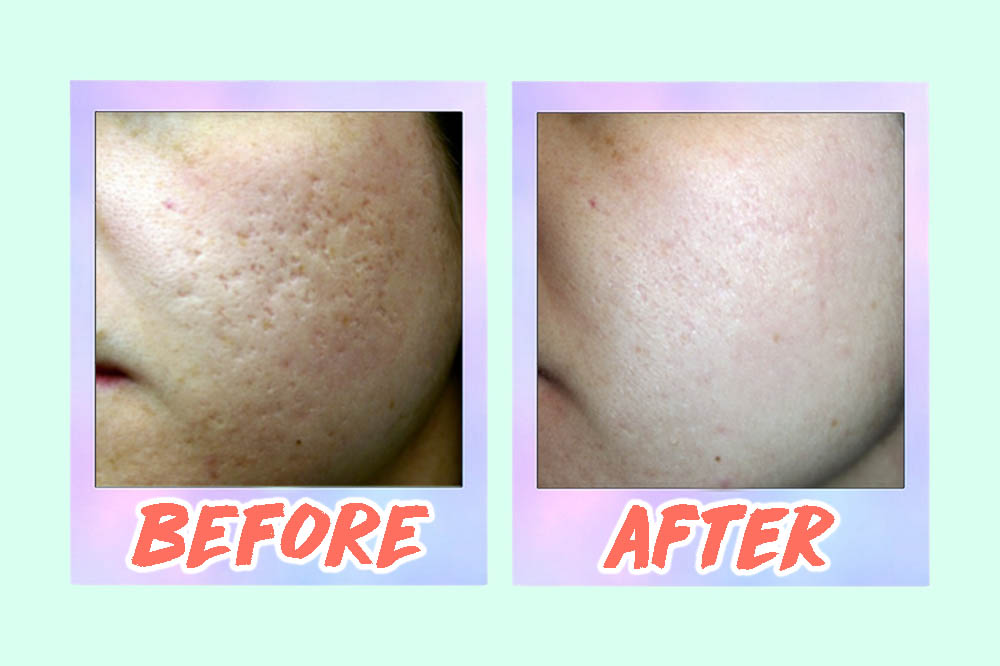 5 Acne Scar Laser Treatments In Singapore From S 88 That Work