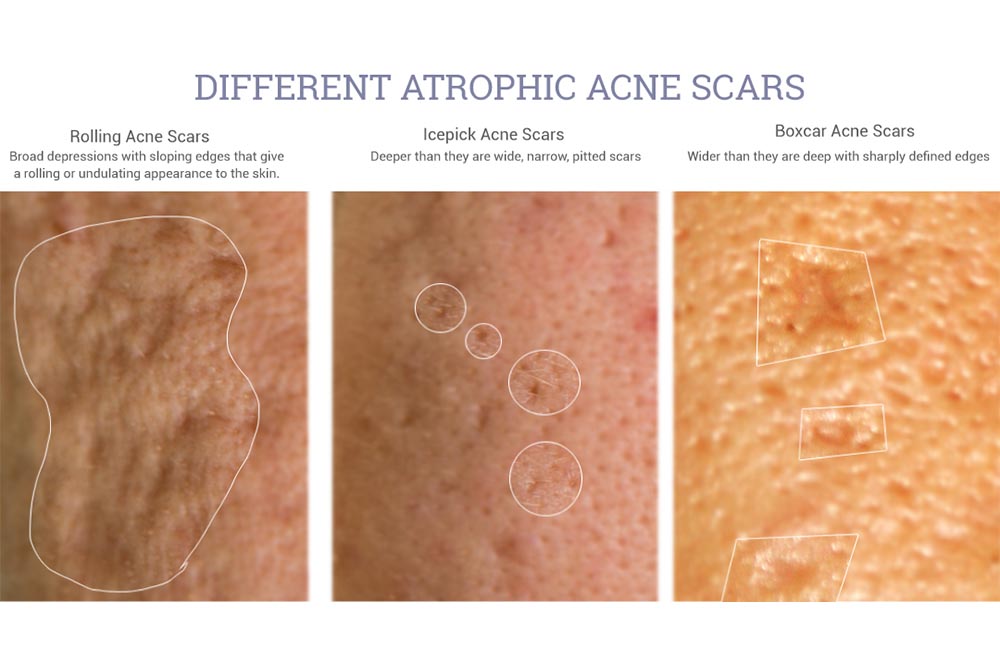 5 Acne Scar Laser Treatments In Singapore From S 88 That Work