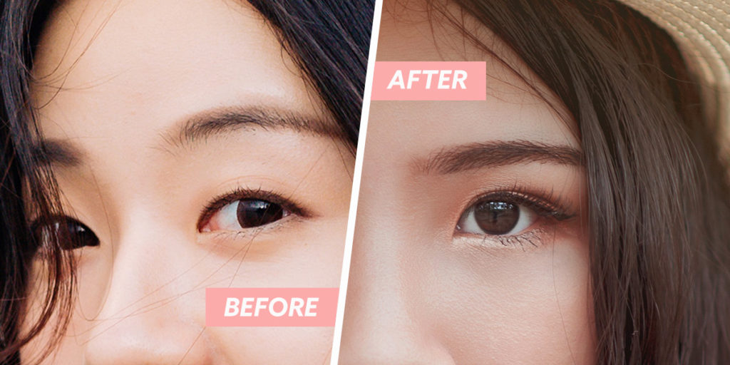 double eyelid surgery cover image