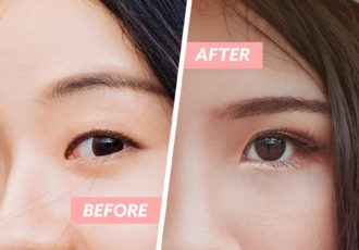 double eyelid surgery cover image