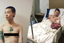 top surgery chris hong