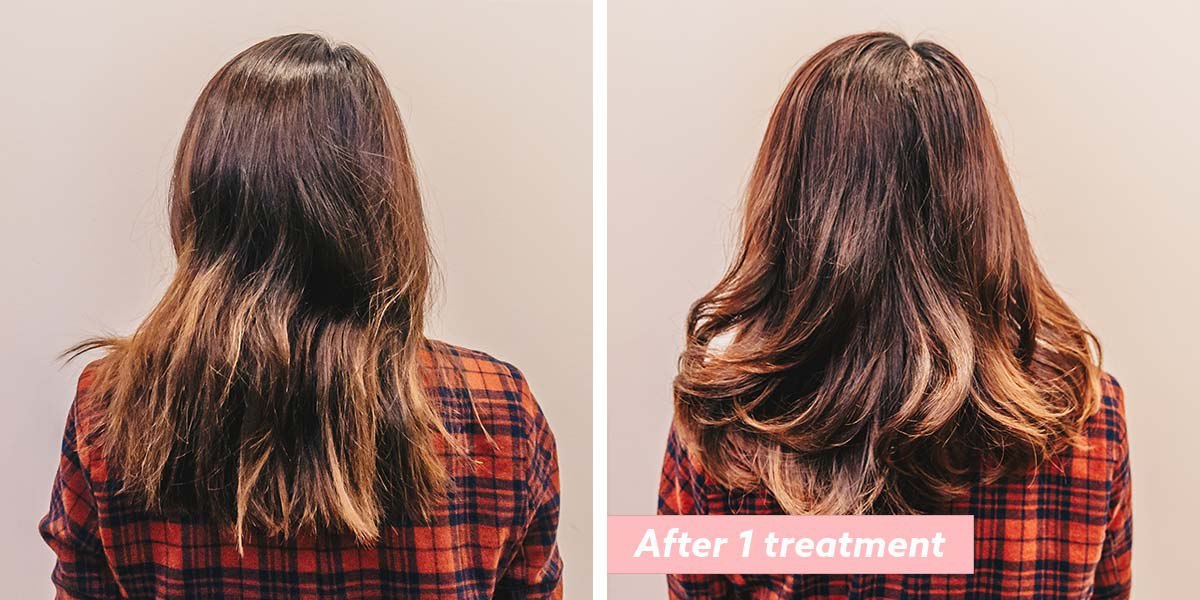 This Hair Loss Treatment Gave Me Back My Confidence After Experiencing  Postpartum Hair Fall 