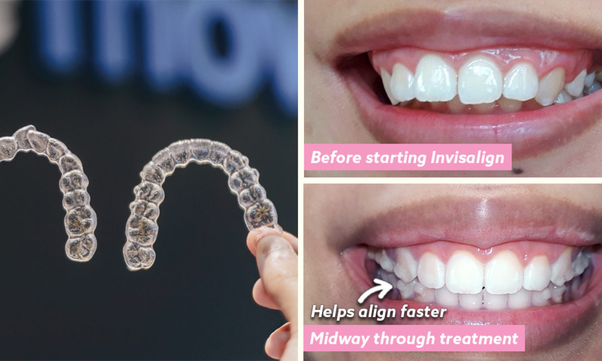 Invisalign In Singapore: 3 Millennials Share Their Invisalign Experiences,  Tips & What To Expect - ZULA.sg