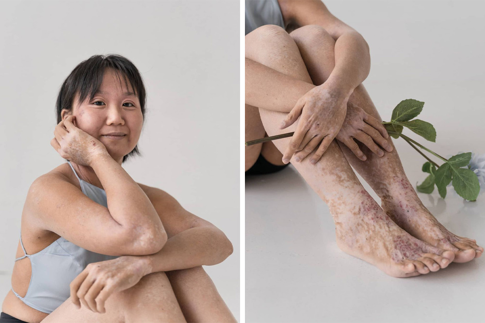Skin Condition Photoshoot Jing Rui Tsw Zula Sg