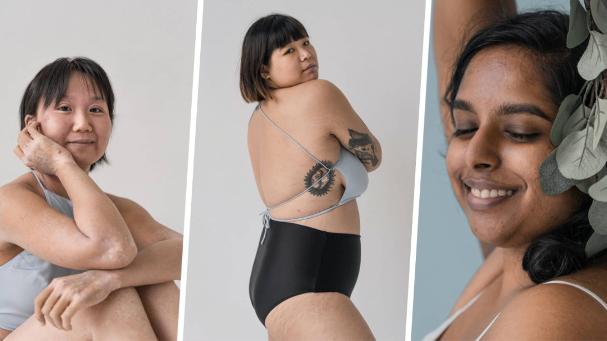 These Inspiring Photos Of Sg Women With Skin Conditions Such As Eczema Show It S Okay Not To Have Perfect Skin Zula Sg