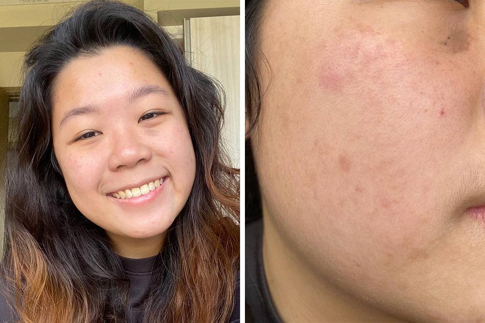 5 Girls Tried La Roche-Posay's Effaclar Serum To See If They Could Get ...