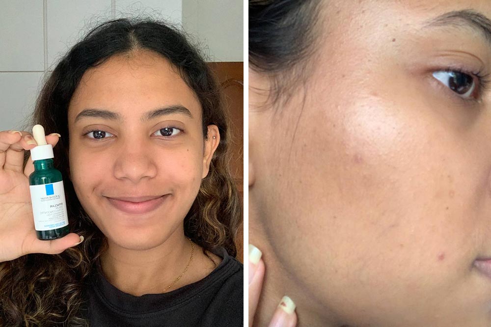 5 Girls Tried La Roche-Posay's Effaclar Serum To See If They Could Get ...