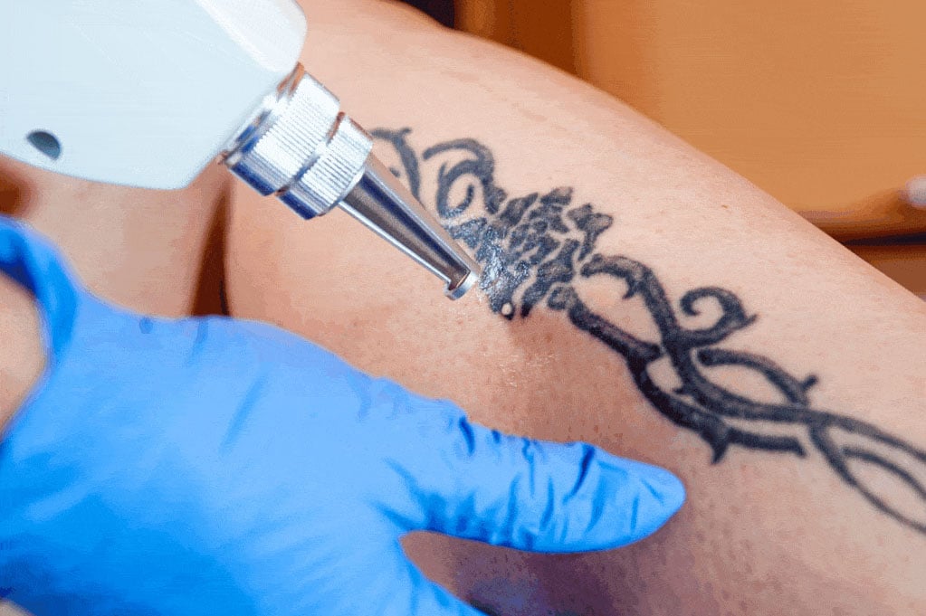 Tattoo Removal Treatment