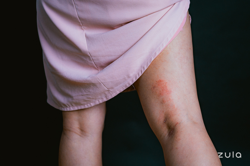 Dealing With Eczema