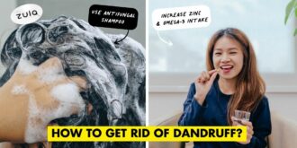 dandruff treatments