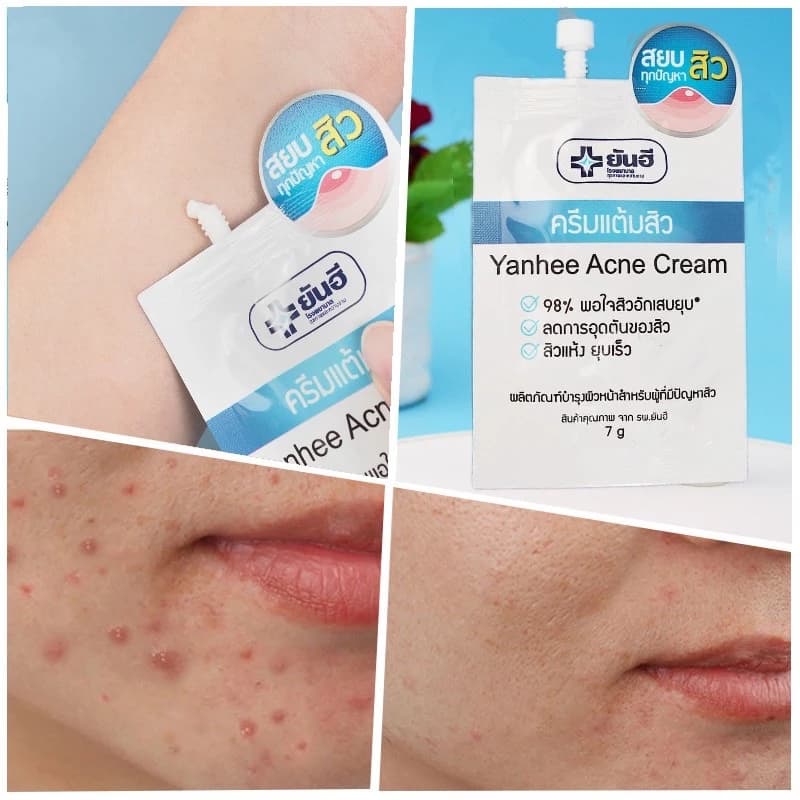 yanhee acne cream