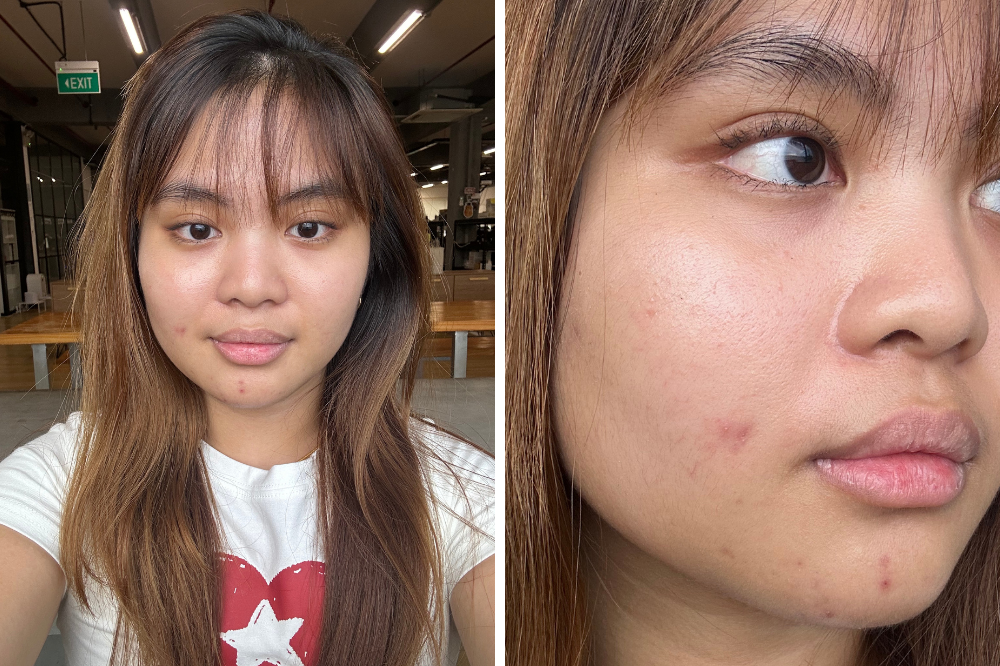 adult acne skincare singapore